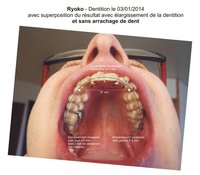 Ryoko - dentition 003 élargie sans arrachage