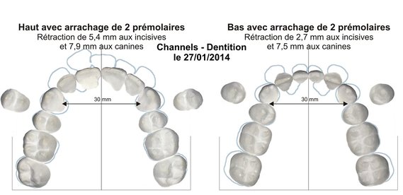Channels - Dentition orthodontie 003 extractions