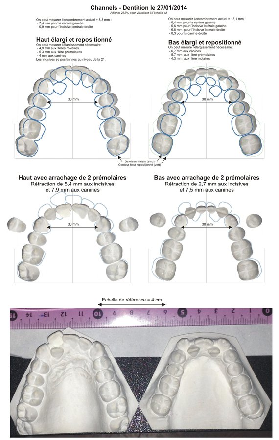 Channels - Dentition orthodontie 001