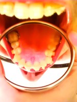 Photo dentition à plat avec un miroir dans la bouche