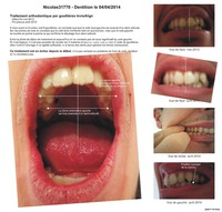 Nicolas31770 - Dentition orthodontie