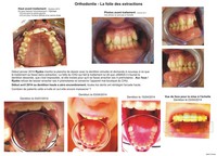 Ryoko - Orthodontie - Folie des extractions 2