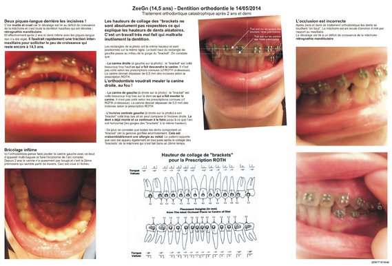 ZeeGn [doctissimo] 2014-05 - Orthodontie mal-traitement et allergie métal