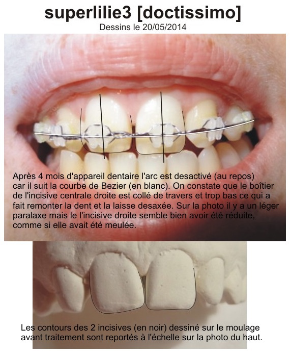 superlilie3 [doctissimo] - 2014-05-20 - orthodontie incisive cassée
