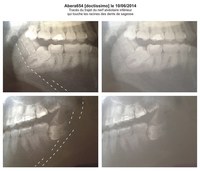 Abera654 - Dents sagesse qui touchent les nerfs