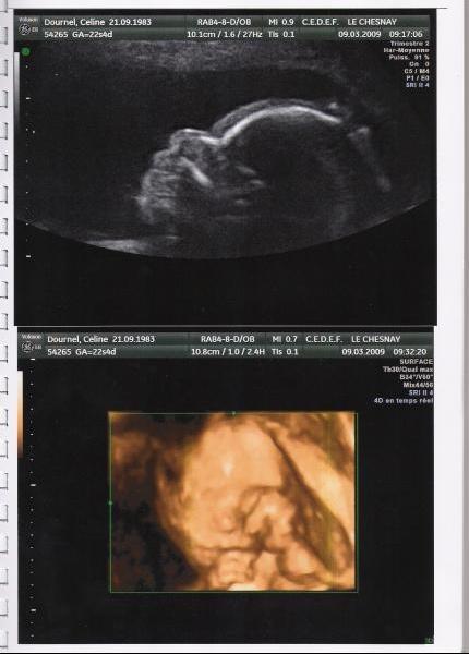 Echo 3d Vous Trouvez Ca Joli Vous Grossesse Forum Grossesse