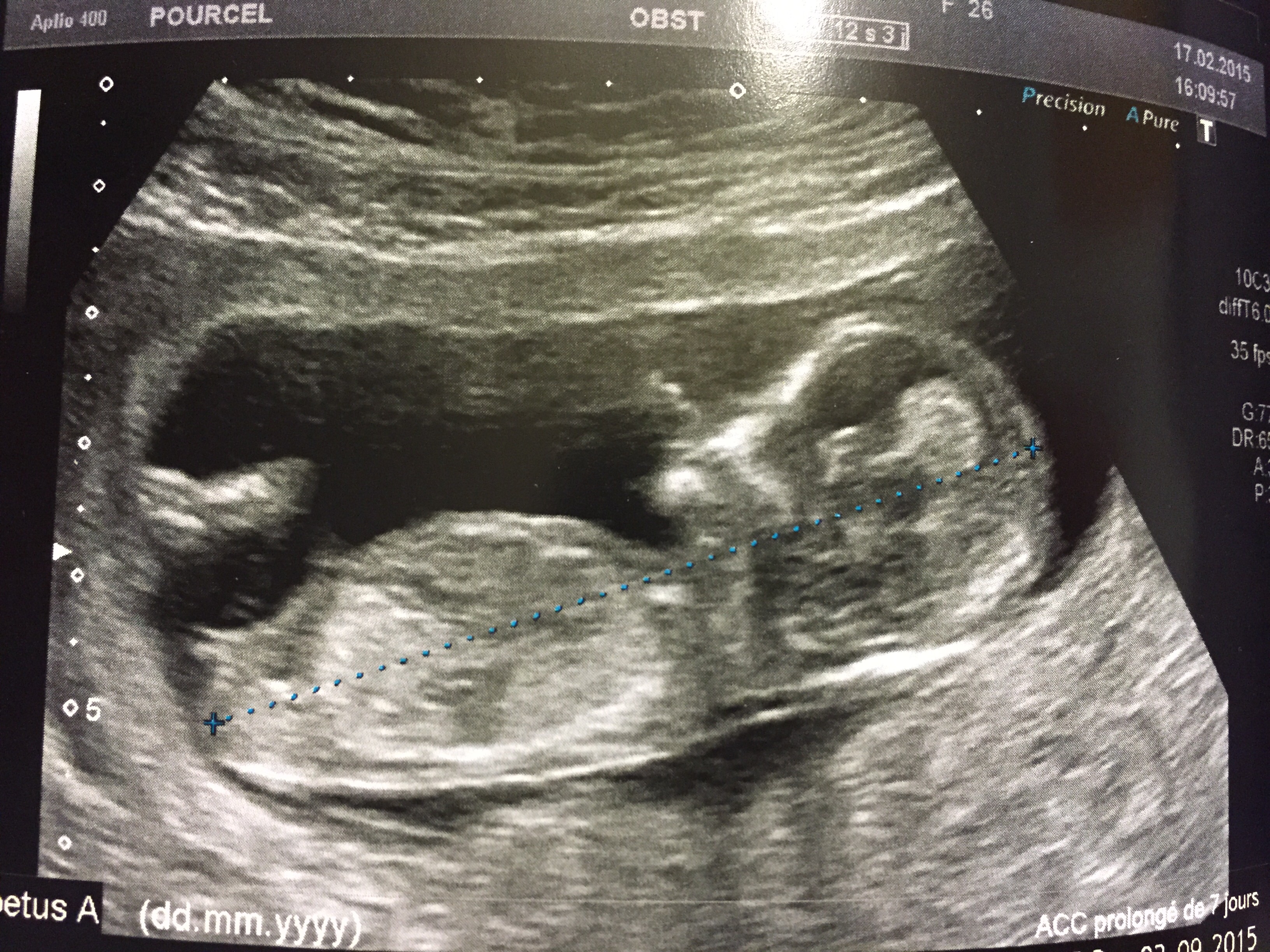 12sa 4 Fille Ou Garcon Echographie Connaitre Le Sexe De Votre Bebe Forum Grossesse Amp Bebe Doctissimo 12sa 4 Fille Ou Garcon Echographie Connaitre Le Sexe De Votre Bebe Forum Grossesse Amp Bebe Doctissimo