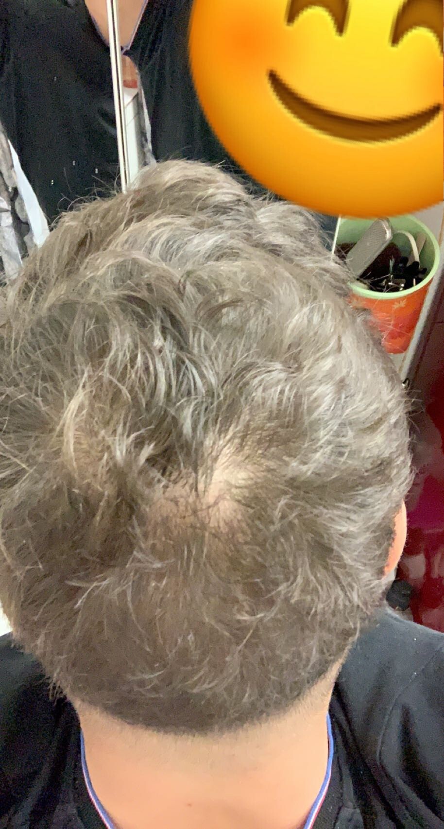 Calvitie homme derriere Clearance