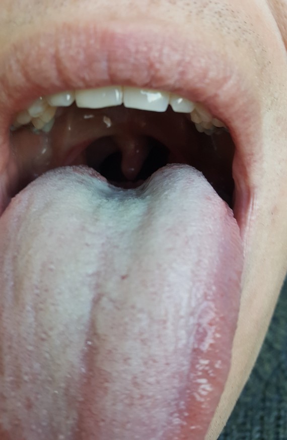 Langue Blanche Cause Et Solution Langue Blanche Cause Et Solution