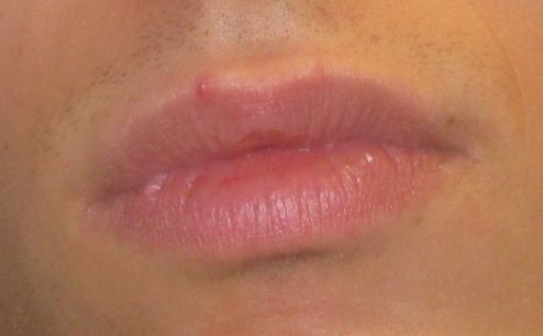 Herpes Acne Psoriasis Et Problemes De Peau Forum Sante Doctissimo