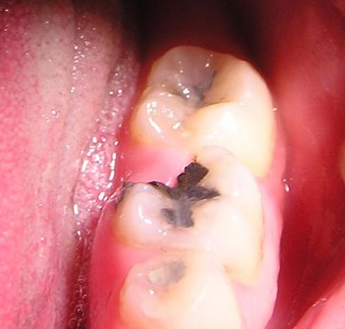 Un Quart De Molaire En Moins C Est Grave Docteur Problemes Dentaires Forum Sante