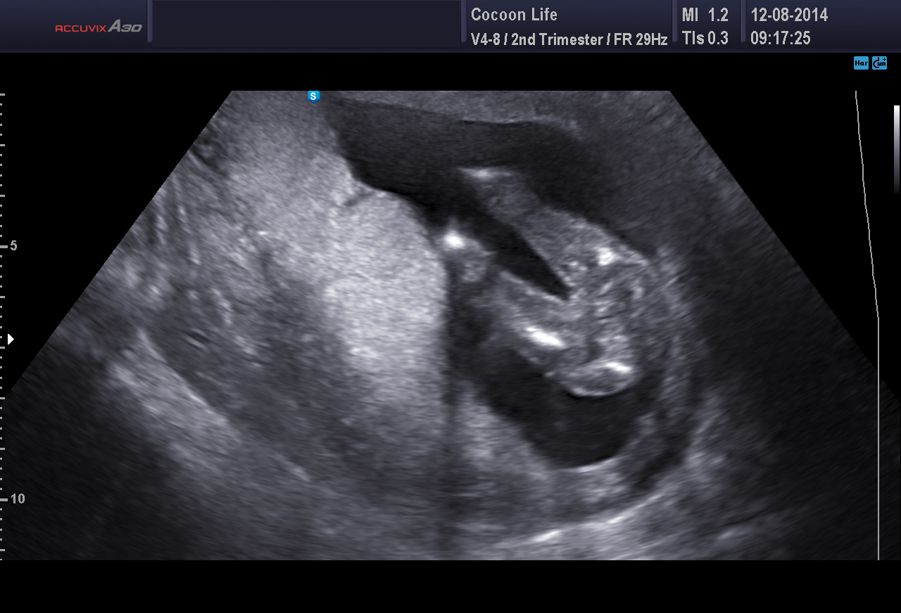 Echo Plaisir 16sa 5 Photos Echographie Connaitre Le Sexe De Votre Bebe Forum Grossesse Amp Bebe Doctissimo Echo Plaisir 16sa 5 Photos Echographie Connaitre Le Sexe De Votre Bebe Forum Grossesse Amp Bebe Doctissimo