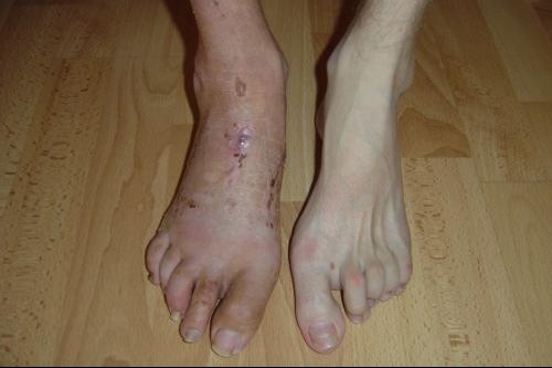 charcot marie tooth maladies genetiques maladies genetiques orphelines rares forum sante doctissimo