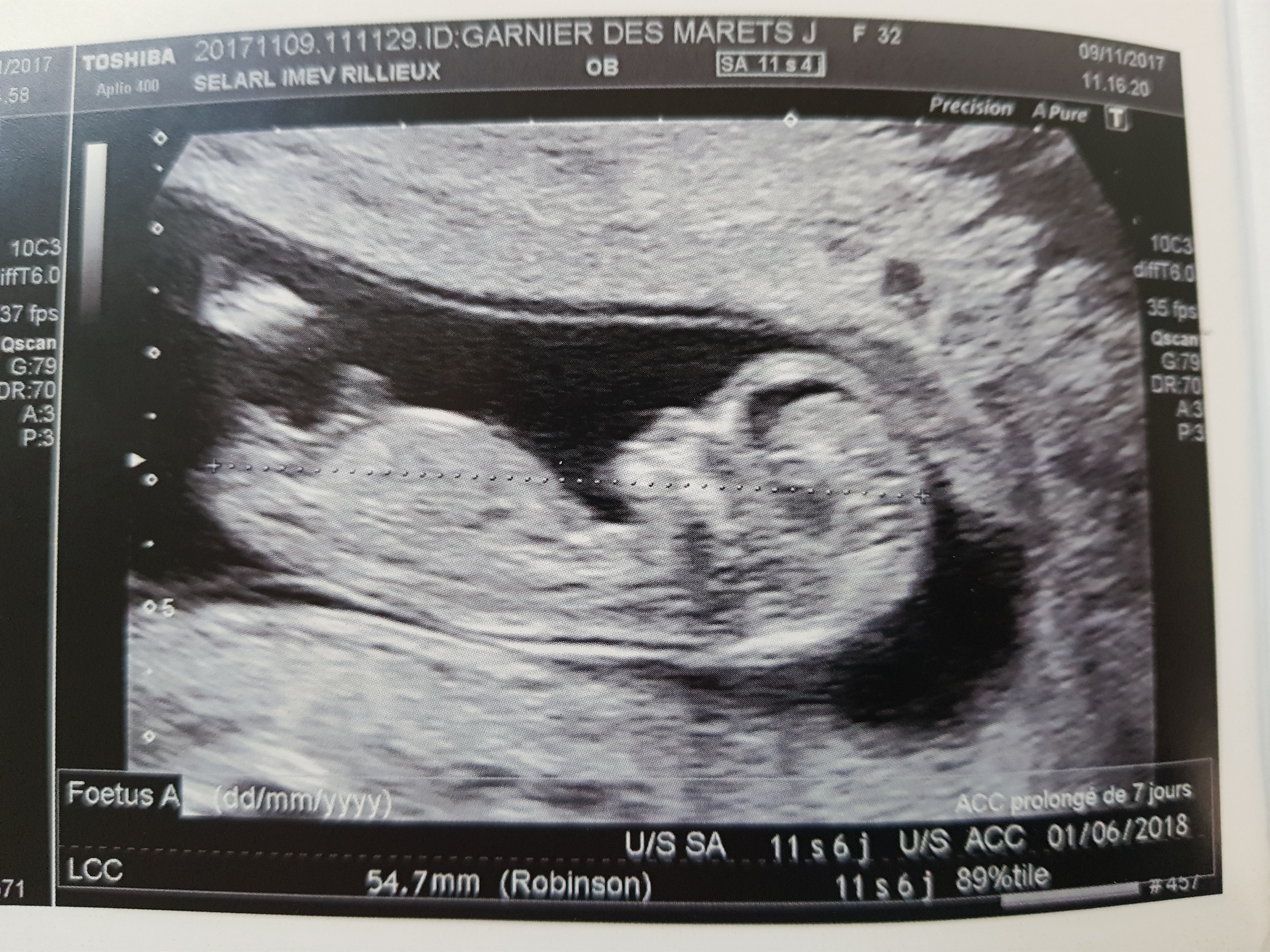 A Vos Avis Echo 11 6 Fille Ou Garcon Echographie Connaitre Le Sexe De Votre Bebe Forum Grossesse Amp Bebe Doctissimo A Vos Avis Echo 11 6 Fille Ou Garcon Echographie Connaitre Le Sexe De Votre Bebe Forum Grossesse Amp Bebe Doctissimo