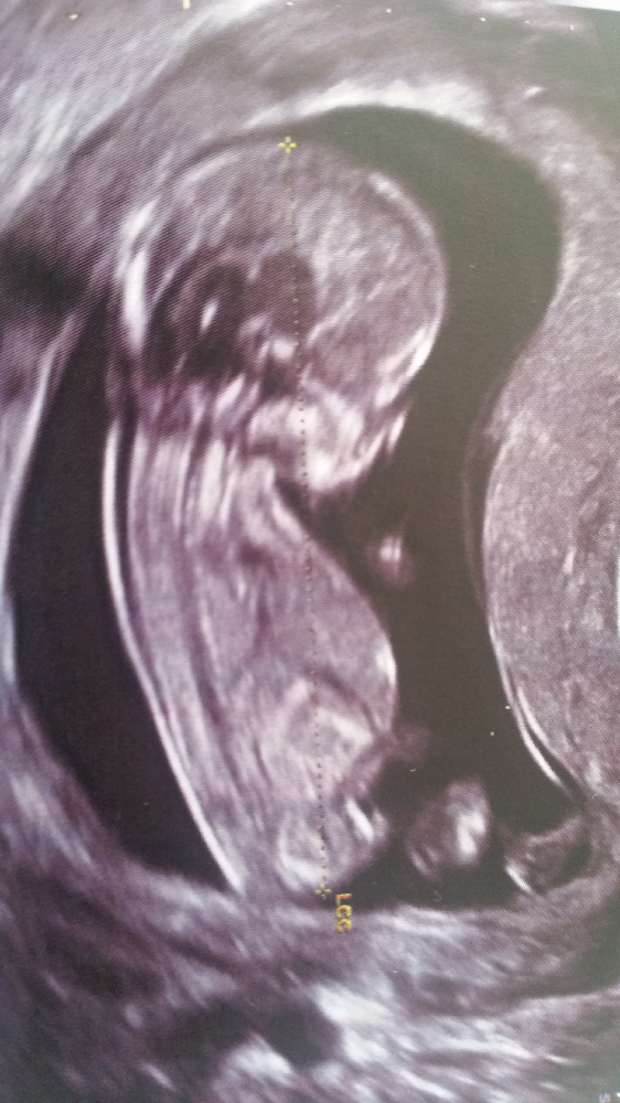 Help Avis Aux Expertes Du Bourgeon Genital Echographie Connaitre Le Sexe De Votre Bebe Forum Grossesse Amp Bebe Doctissimo Help Avis Aux Expertes Du Bourgeon Genital Echographie Connaitre Le Sexe De Votre Bebe Forum Grossesse Amp Bebe Doctissimo