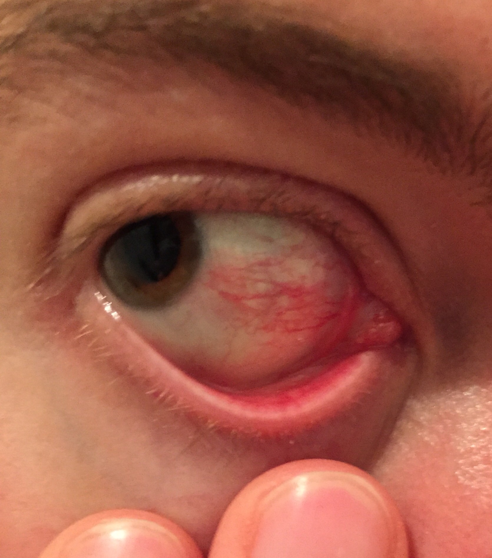 Oeil Rouge Episclerite Myopie Cataracte Et Problemes De Vue Forum Sante Doctissimo Oeil Rouge Episclerite Myopie Cataracte Et Problemes De Vue Forum Sante Doctissimo