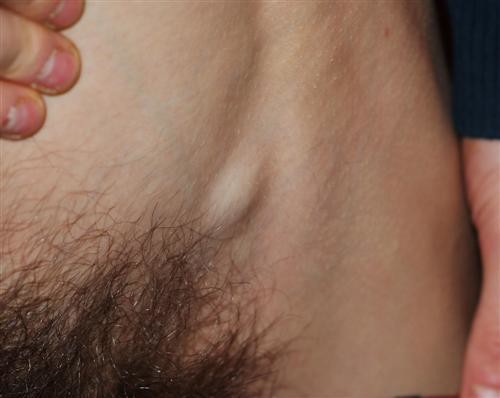 Ganglion Enfle Et Plaque Rouge En Bas Du Dos Zona Dossier Medical Personnel Forum Vie Pratique Doctissimo Ganglion Enfle Et Plaque Rouge En Bas Du Dos Zona Dossier Medical Personnel Forum Vie Pratique Doctissimo