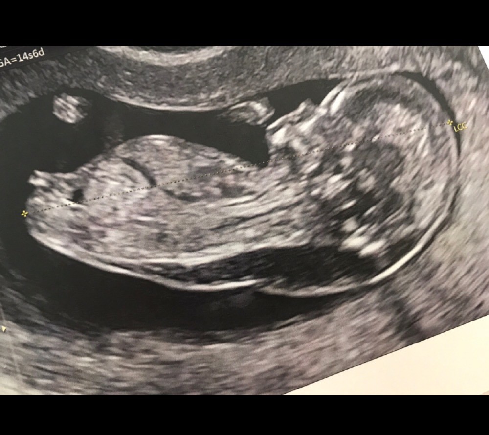 Clarte Nucale A 5 5mm Amniocentese Forum Grossesse Amp Bebe Doctissimo Clarte Nucale A 5 5mm Amniocentese Forum Grossesse Amp Bebe Doctissimo