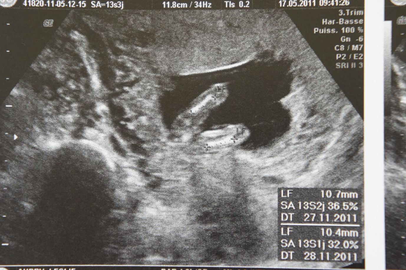 Vos Echo 12 13sa Vue De Dessous Sous Les Fesses Echographie Connaitre Le Sexe De Votre Bebe Forum Grossesse Amp Bebe Doctissimo