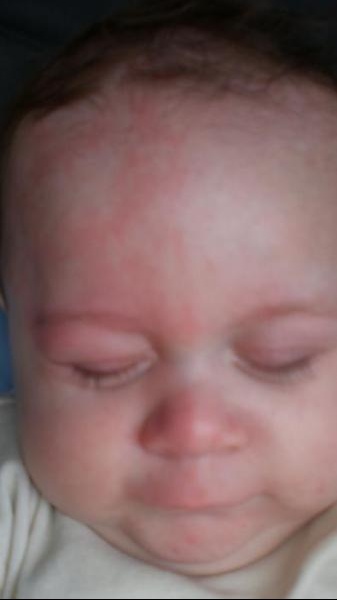 Visage Rouge Je M Inquiete Vraiment Bebe Grandit Forum Grossesse Amp Bebe Doctissimo Visage Rouge Je M Inquiete Vraiment Bebe Grandit Forum Grossesse Amp Bebe Doctissimo