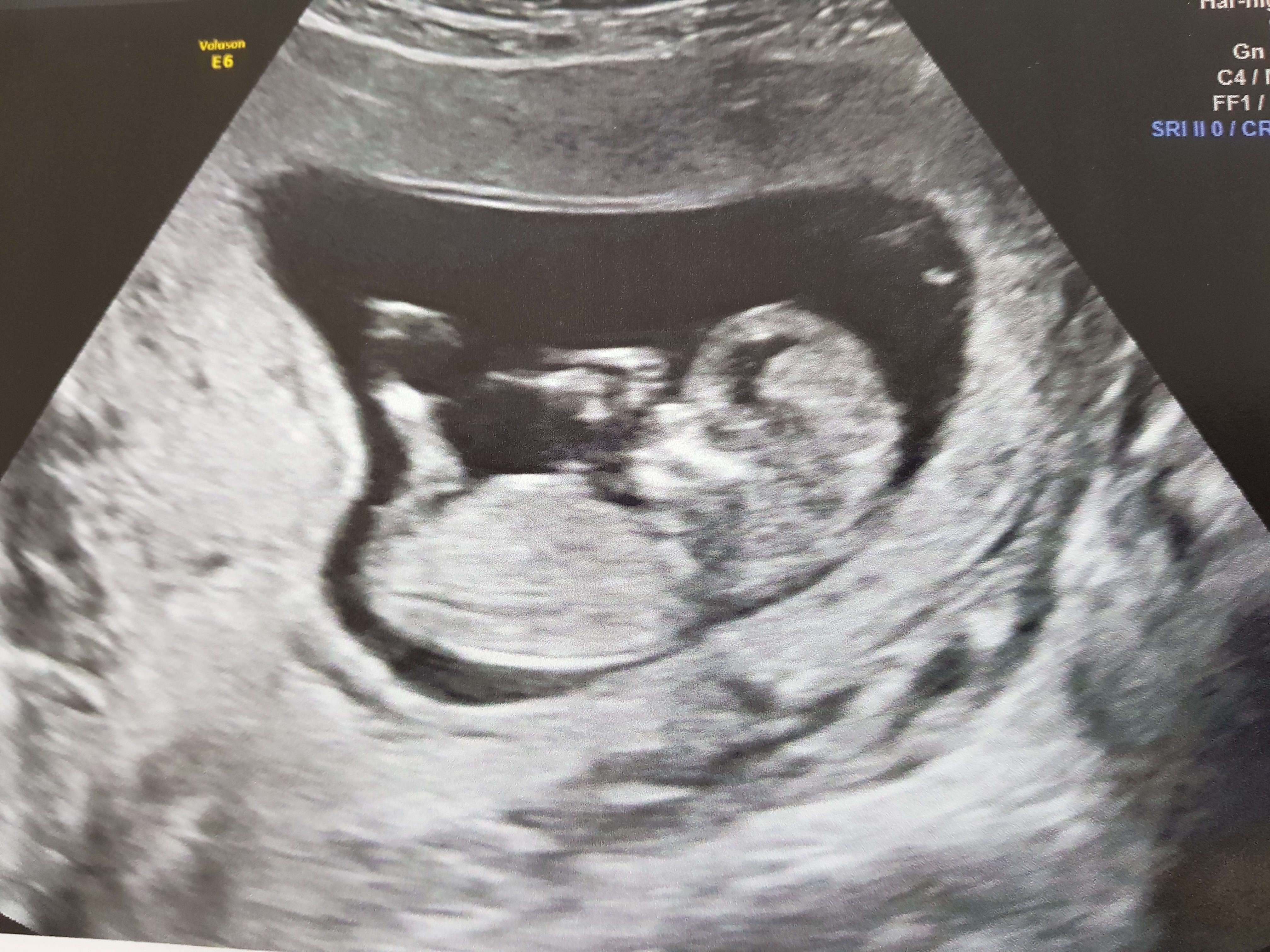 Sexe Bebe Vos Pronostics Apres Echo T1 Futures Mamans Forum Grossesse Amp Bebe Doctissimo Sexe Bebe Vos Pronostics Apres Echo T1 Futures Mamans Forum Grossesse Amp Bebe Doctissimo