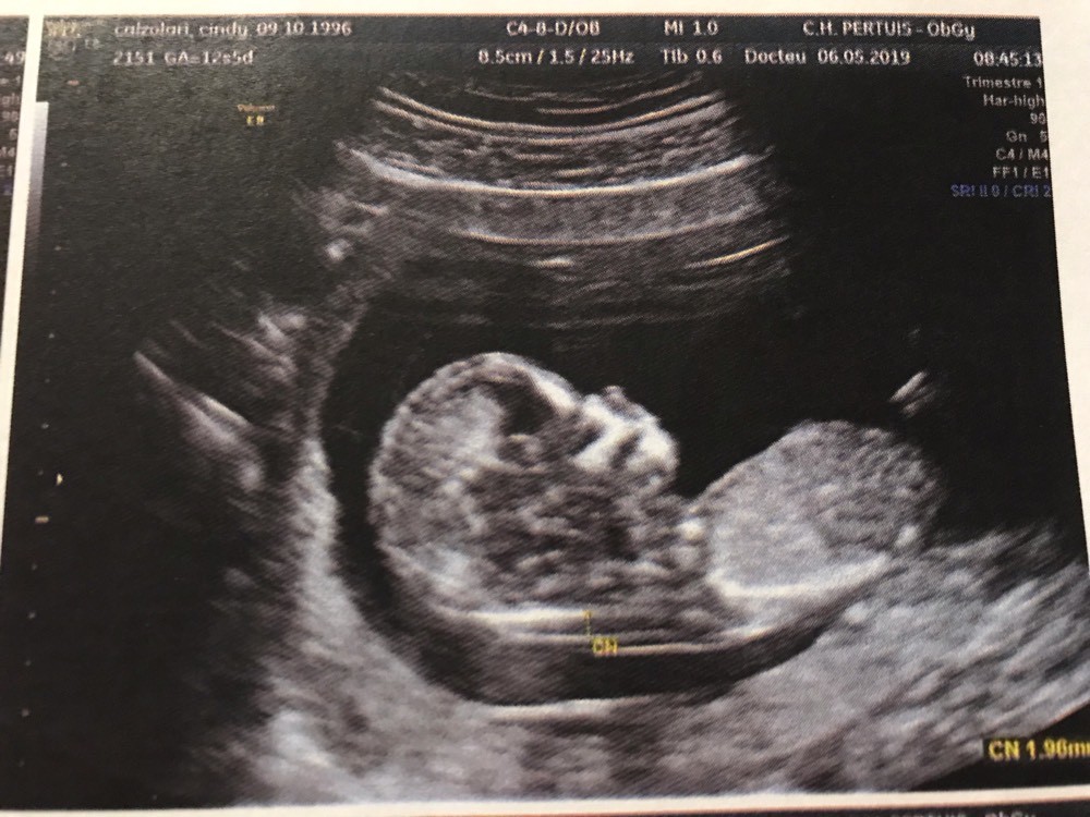 Echo 13sa Pas De Bourgeon Echographie Connaitre Le Sexe De Votre Bebe Forum Grossesse Amp Bebe Doctissimo Echo 13sa Pas De Bourgeon Echographie Connaitre Le Sexe De Votre Bebe Forum Grossesse Amp Bebe Doctissimo