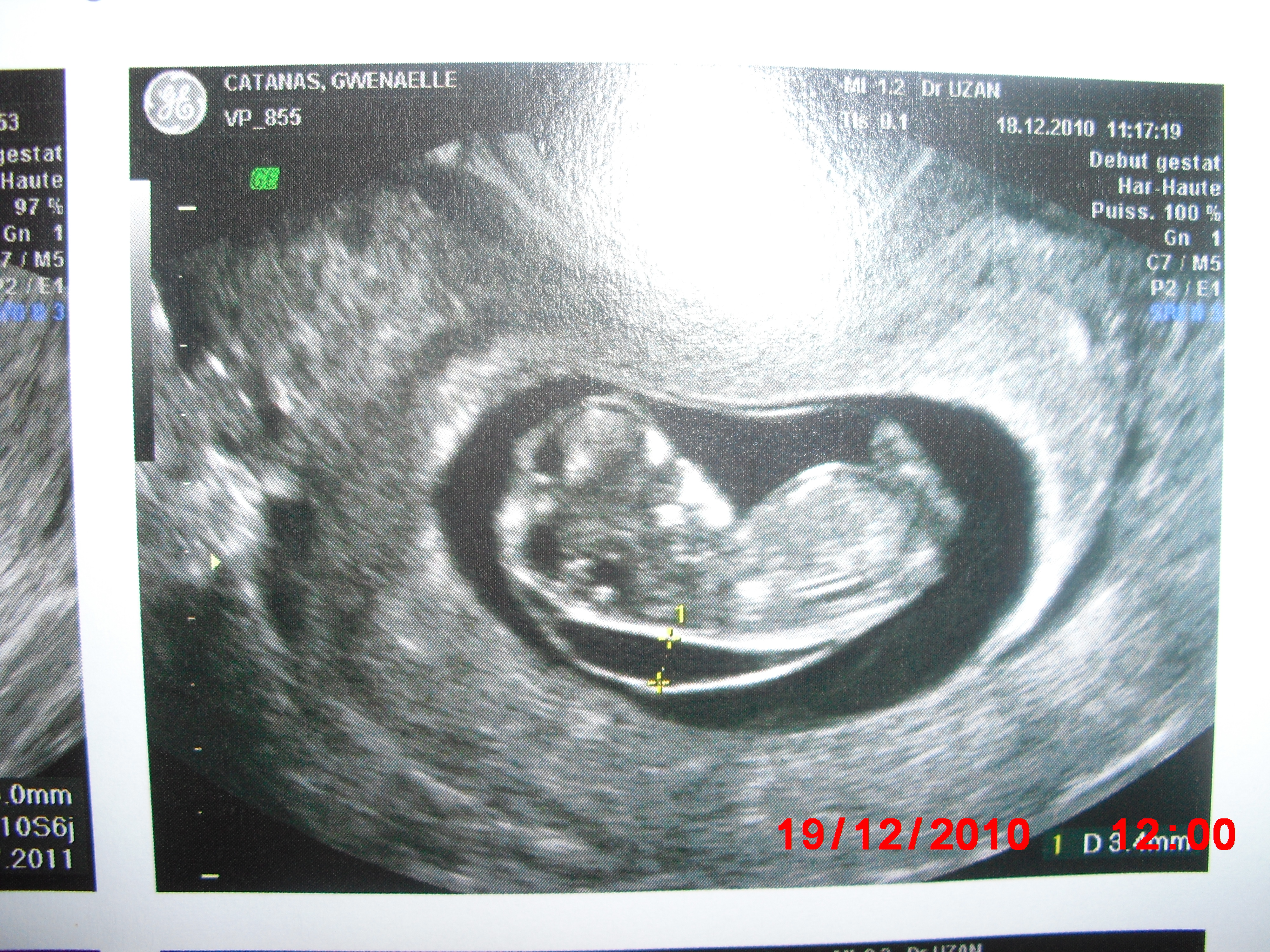 Clarte Nucale 3 8mm Page 2 Amniocentese Forum Grossesse Amp Bebe Doctissimo Clarte Nucale 3 8mm Page 2 Amniocentese Forum Grossesse Amp Bebe Doctissimo