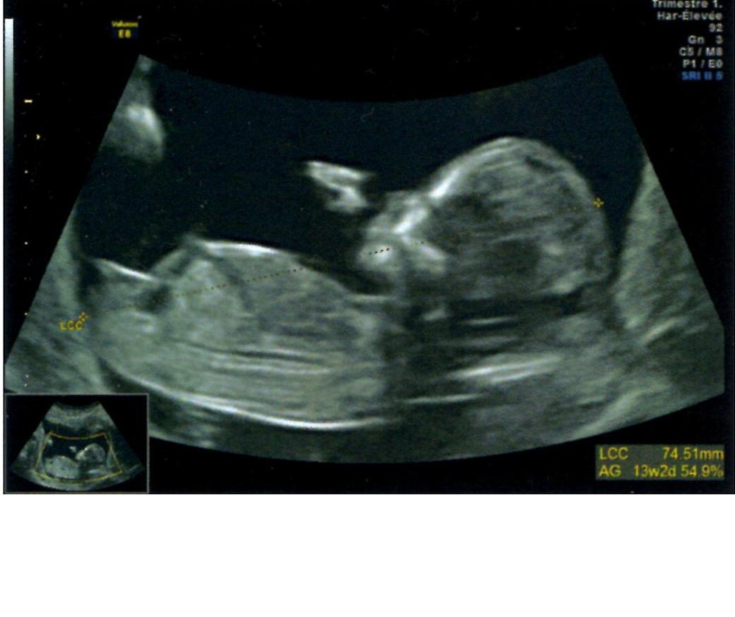 Tubercule Fille Ou Garcon Echographie Connaitre Le Sexe De Votre Bebe Forum Grossesse Amp Bebe Doctissimo Tubercule Fille Ou Garcon Echographie Connaitre Le Sexe De Votre Bebe Forum Grossesse Amp Bebe Doctissimo