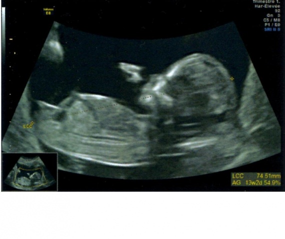 Tubercule Fille Ou Garcon Tubercule Fille Ou Garcon