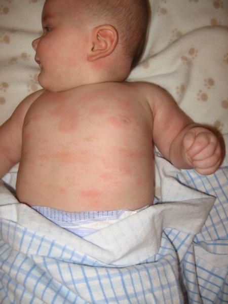 C Est Confirme Allergies Aux Proteines Bovines Mamans Et Futures Mamans Du Quebec Forum Grossesse Amp Bebe Doctissimo C Est Confirme Allergies Aux Proteines Bovines Mamans Et Futures Mamans Du Quebec Forum Grossesse Amp Bebe Doctissimo