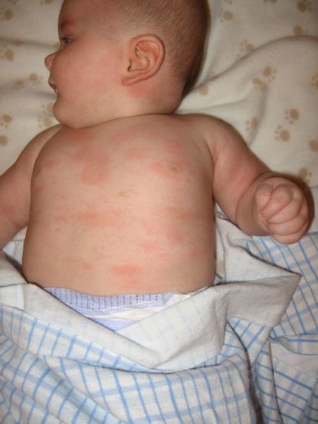 C Est Confirme Allergies Aux Proteines Bovines C Est Confirme Allergies Aux Proteines Bovines