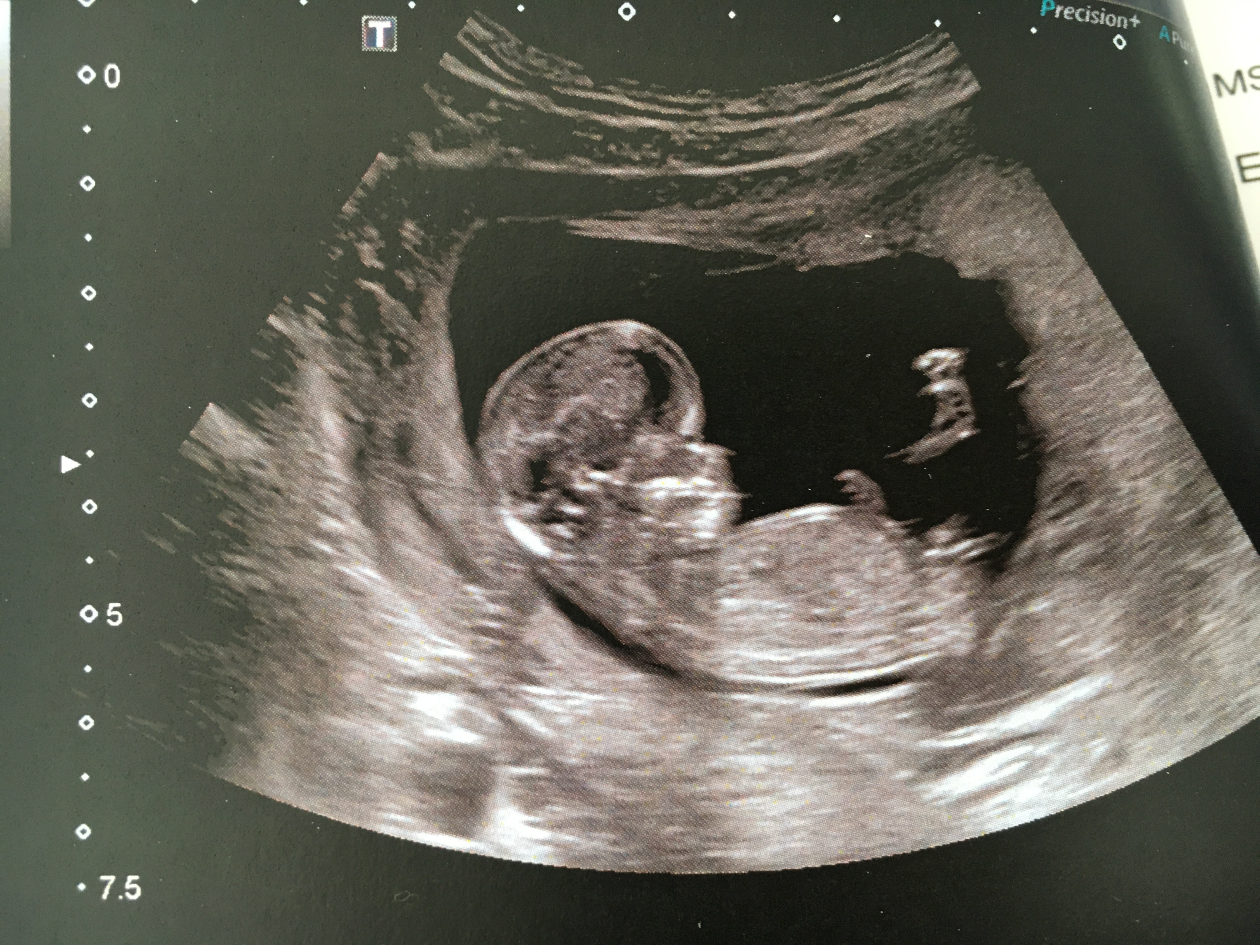 Avis Tubercule Genital 3 Echographie Connaitre Le Sexe De Votre Bebe Forum Grossesse Amp Bebe Doctissimo Avis Tubercule Genital 3 Echographie Connaitre Le Sexe De Votre Bebe Forum Grossesse Amp Bebe Doctissimo