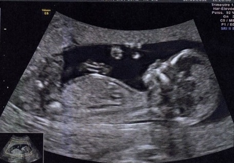 Echo Des 12 Sa 5 Fille Ou Garcon Please Echographie Connaitre Le Sexe De Votre Bebe Forum Grossesse Amp Bebe Doctissimo Echo Des 12 Sa 5 Fille Ou Garcon Please Echographie Connaitre Le Sexe De Votre Bebe Forum Grossesse Amp Bebe Doctissimo