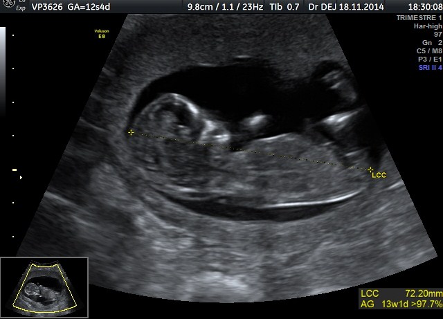 Echo 12sa 6 Je Vois Pas Le Bourgeon Et Vous Echographie Connaitre Le Sexe De Votre Bebe Forum Grossesse Amp Bebe Doctissimo Echo 12sa 6 Je Vois Pas Le Bourgeon Et Vous Echographie Connaitre Le Sexe De Votre Bebe Forum Grossesse Amp Bebe Doctissimo