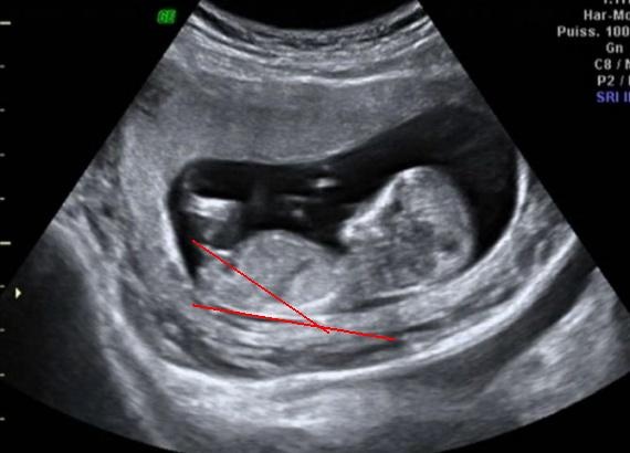 Photo Echo D Apres Video 12sa 5 Echographie Connaitre Le Sexe De Votre Bebe Forum Grossesse Amp Bebe Doctissimo Photo Echo D Apres Video 12sa 5 Echographie Connaitre Le Sexe De Votre Bebe Forum Grossesse Amp Bebe Doctissimo