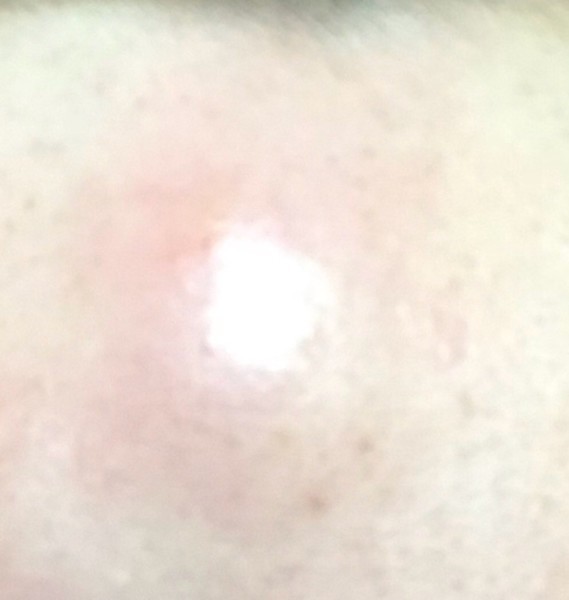 [ URGENT ] enorme bouton bosse... besoin d’aide