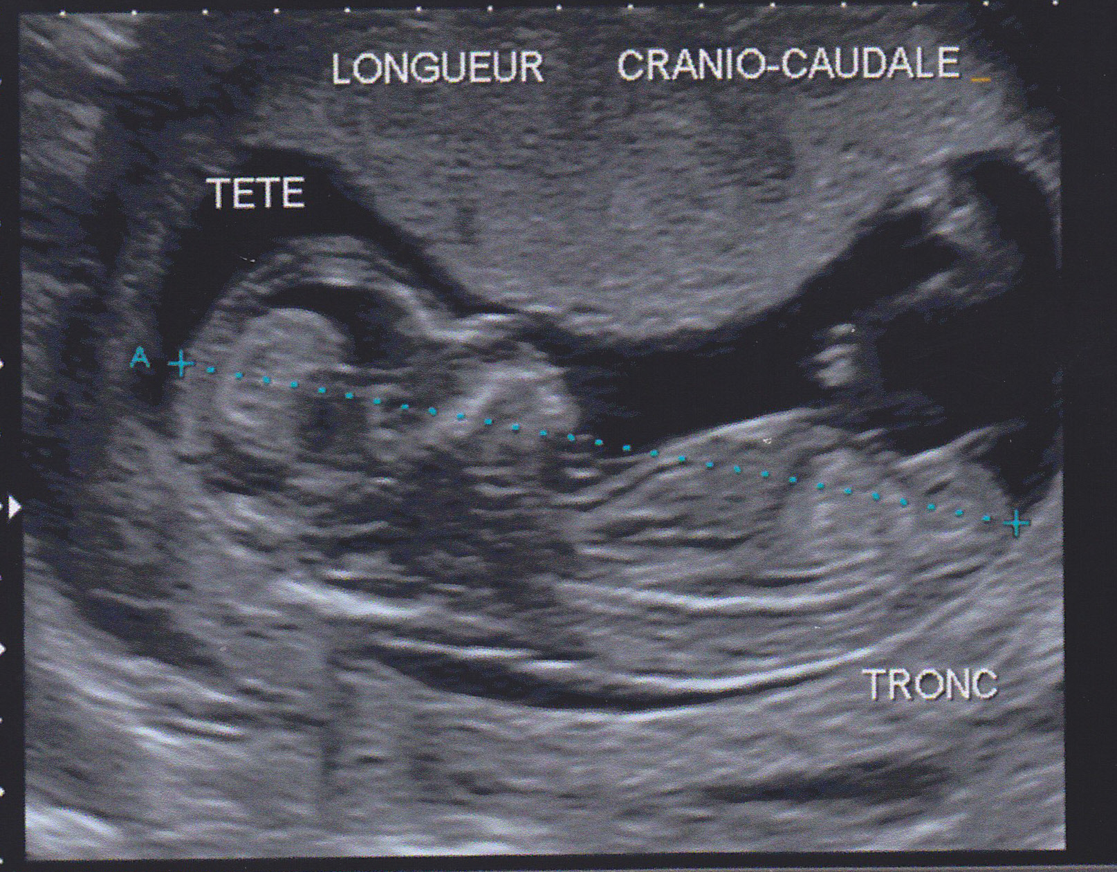 Sexe Bebe En Fonction De L Echo Des 12 Sa Echographie Connaitre Le Sexe De Votre Bebe Forum Grossesse Amp Bebe Doctissimo Sexe Bebe En Fonction De L Echo Des 12 Sa Echographie Connaitre Le Sexe De Votre Bebe Forum Grossesse Amp Bebe Doctissimo