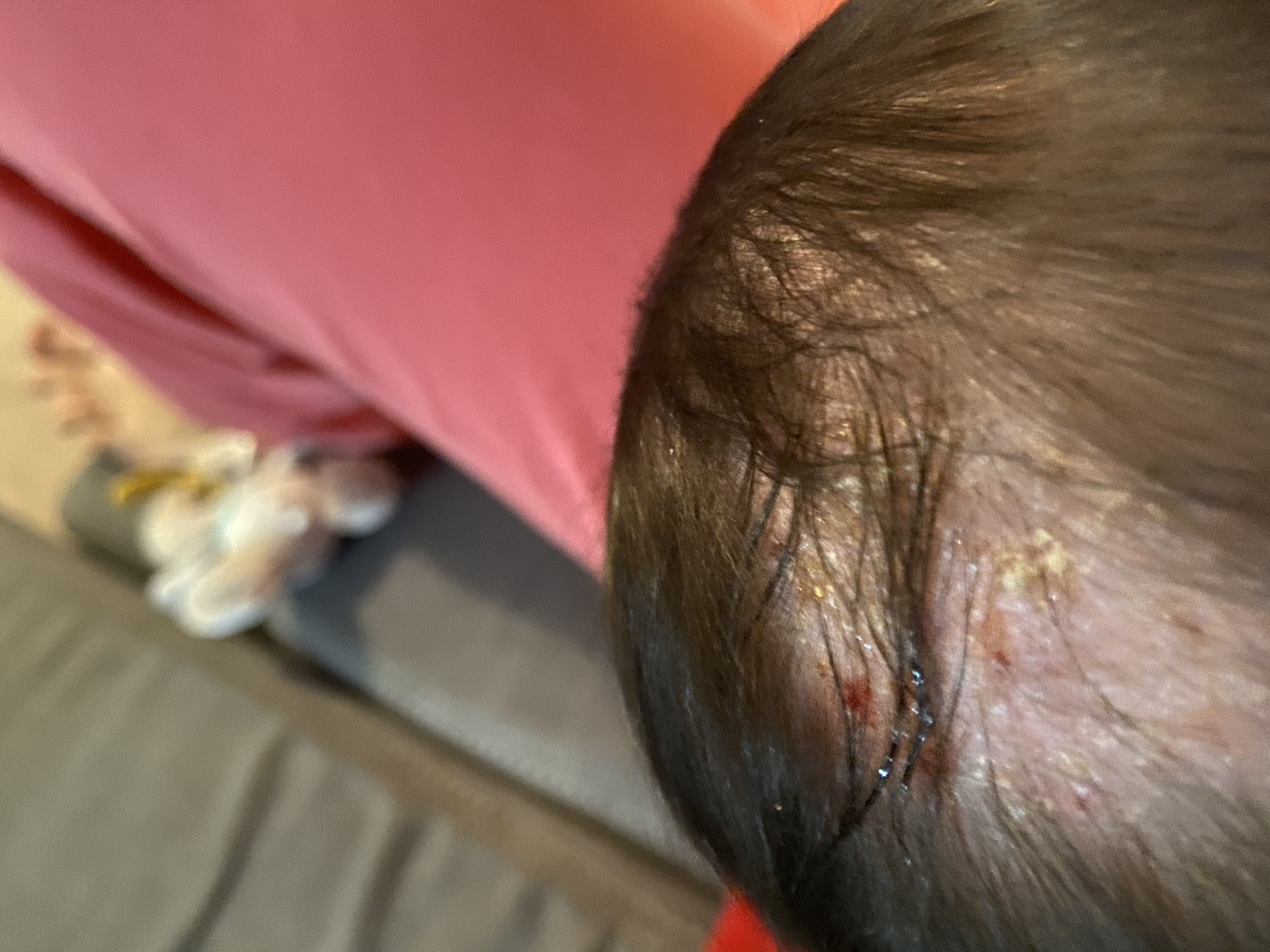 Boutons Qui Suintent Cuir Chevelu Sante De L Enfant Forum Sante Doctissimo Boutons Qui Suintent Cuir Chevelu Sante De L Enfant Forum Sante Doctissimo