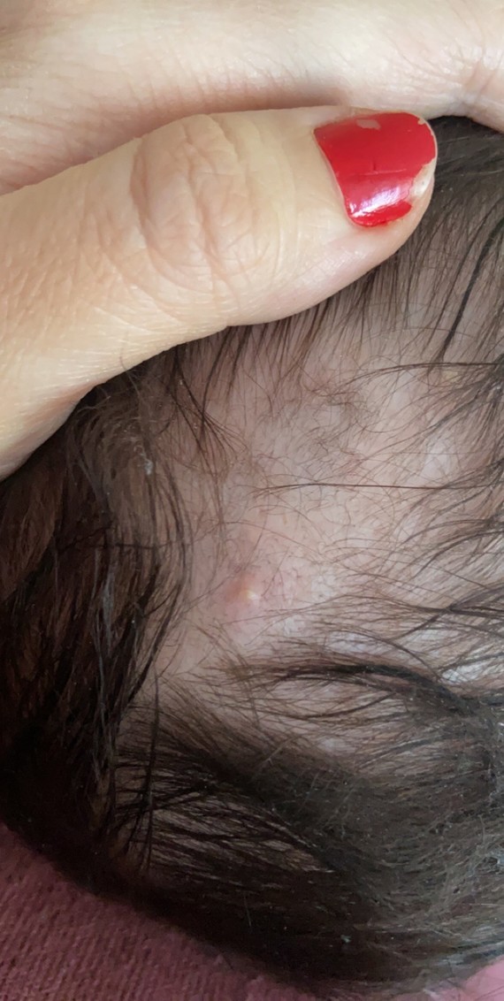 Boutons Qui Suintent Cuir Chevelu Sante De L Enfant Forum Sante Doctissimo Boutons Qui Suintent Cuir Chevelu Sante De L Enfant Forum Sante Doctissimo