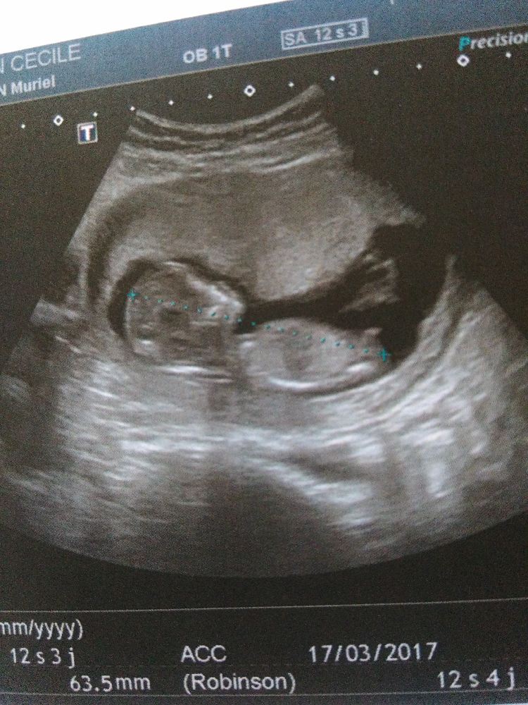 Echographie 12 Semaines 3jours Bourgeon Tendancieux Echographie Connaitre Le Sexe De Votre Bebe Forum Grossesse Amp Bebe Doctissimo Echographie 12 Semaines 3jours Bourgeon Tendancieux Echographie Connaitre Le Sexe De Votre Bebe Forum Grossesse Amp Bebe Doctissimo