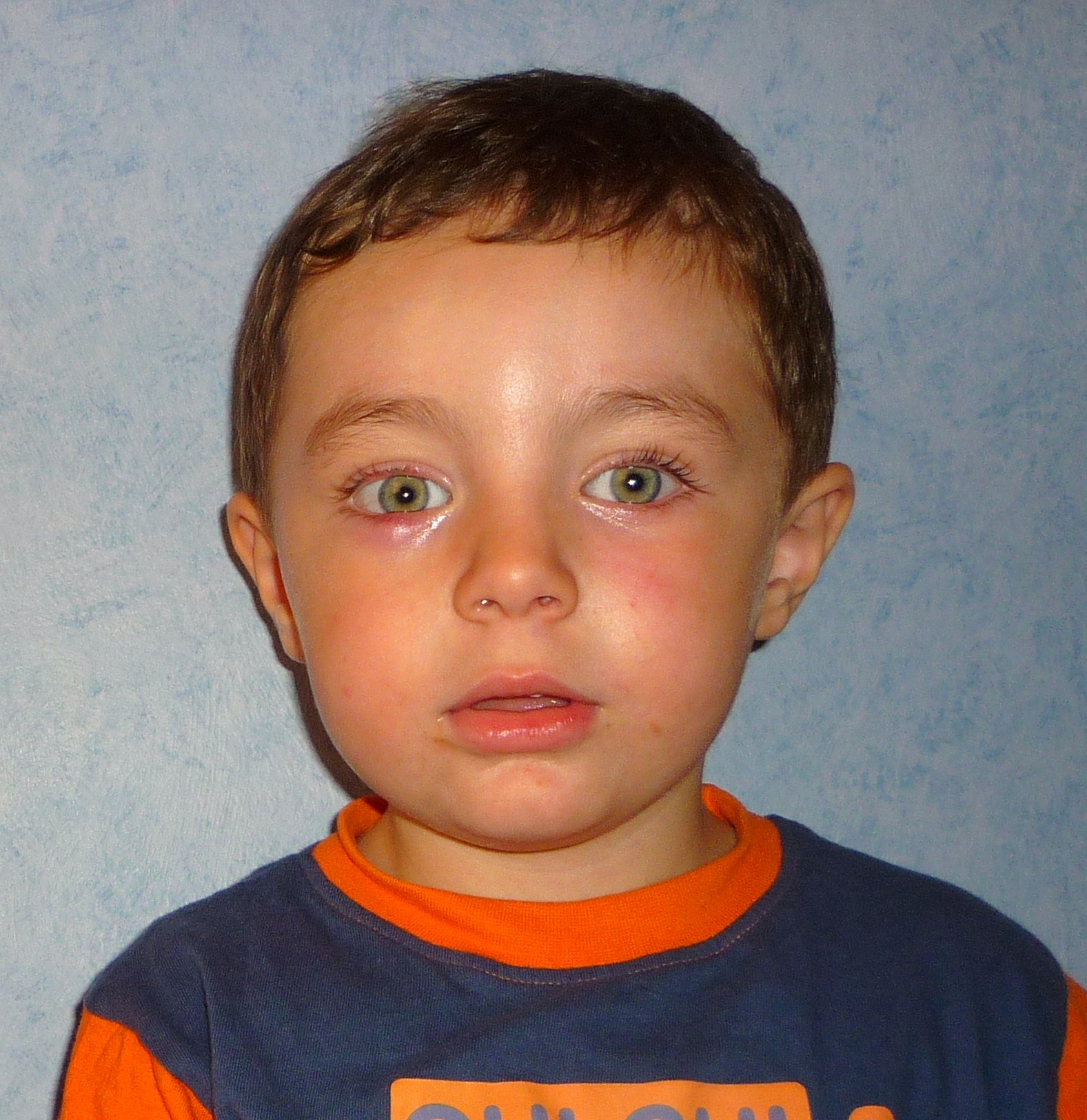 Chalazion Qui Ne Part Pas Help Myopie Cataracte Et Problemes De Vue Forum Sante Doctissimo