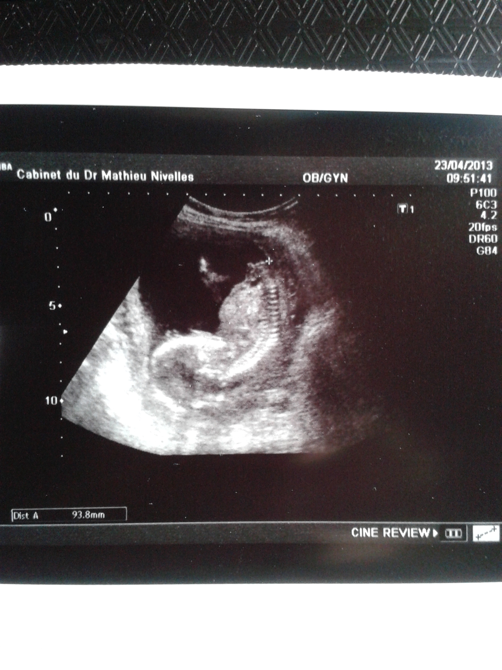 Erreur Sur L Orientation Du Tubercule Echographie Connaitre Le Sexe De Votre Bebe Forum Grossesse Amp Bebe Doctissimo Erreur Sur L Orientation Du Tubercule Echographie Connaitre Le Sexe De Votre Bebe Forum Grossesse Amp Bebe Doctissimo