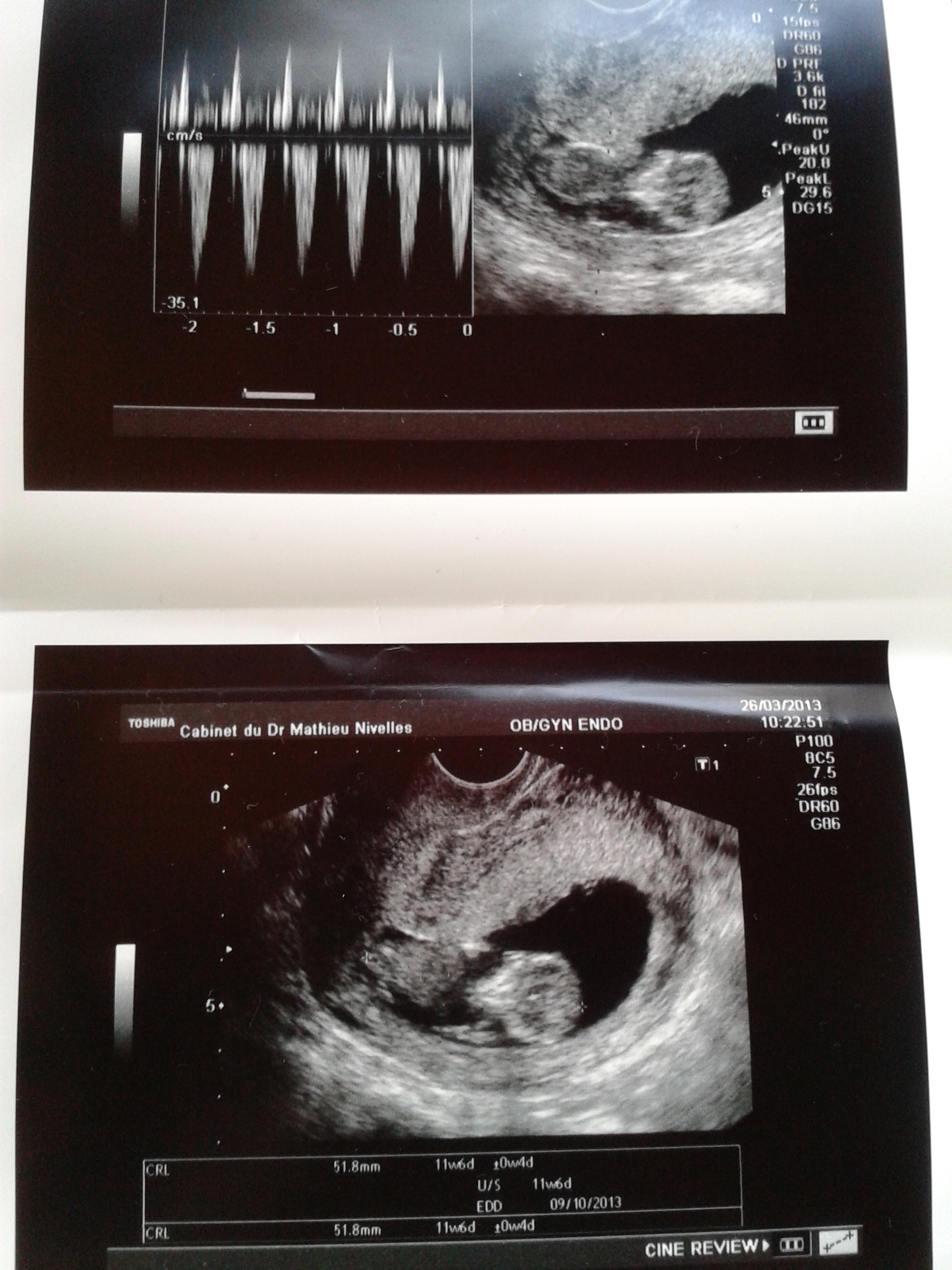 Erreur Sur L Orientation Du Tubercule Echographie Connaitre Le Sexe De Votre Bebe Forum Grossesse Amp Bebe Doctissimo