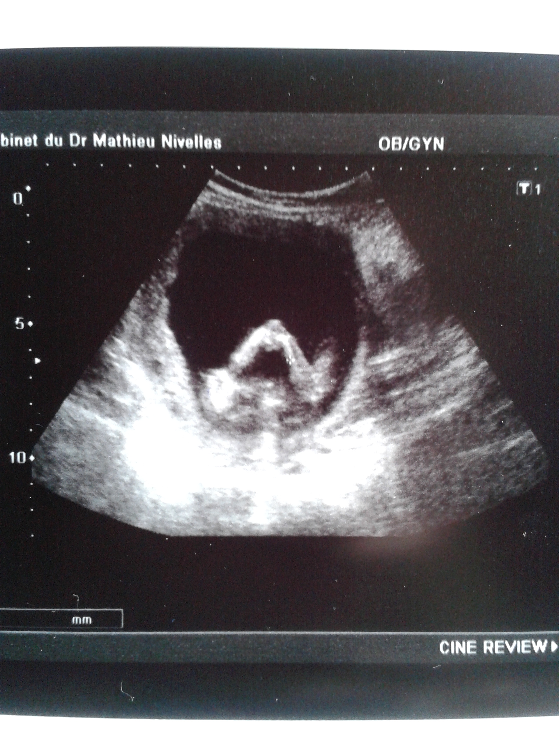 Erreur Sur L Orientation Du Tubercule Echographie Connaitre Le Sexe De Votre Bebe Forum Grossesse Amp Bebe Doctissimo Erreur Sur L Orientation Du Tubercule Echographie Connaitre Le Sexe De Votre Bebe Forum Grossesse Amp Bebe Doctissimo