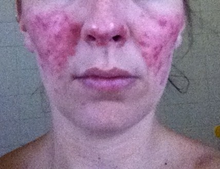 Plaques rouges boutonneuses sur le visage