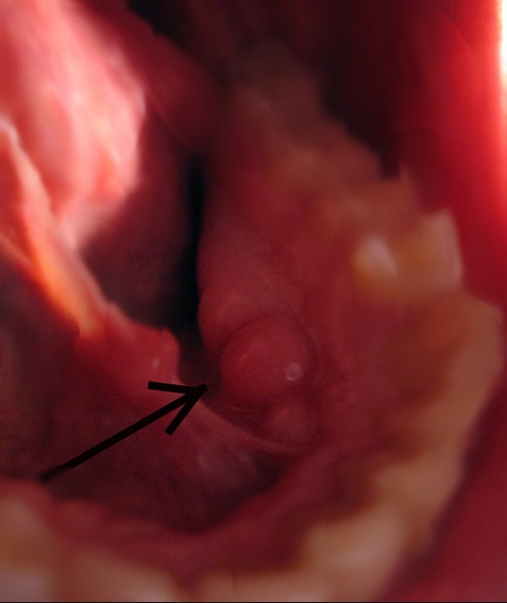 Probleme De Boule Sous La Machoire Probleme De Boule Sous La Machoire
