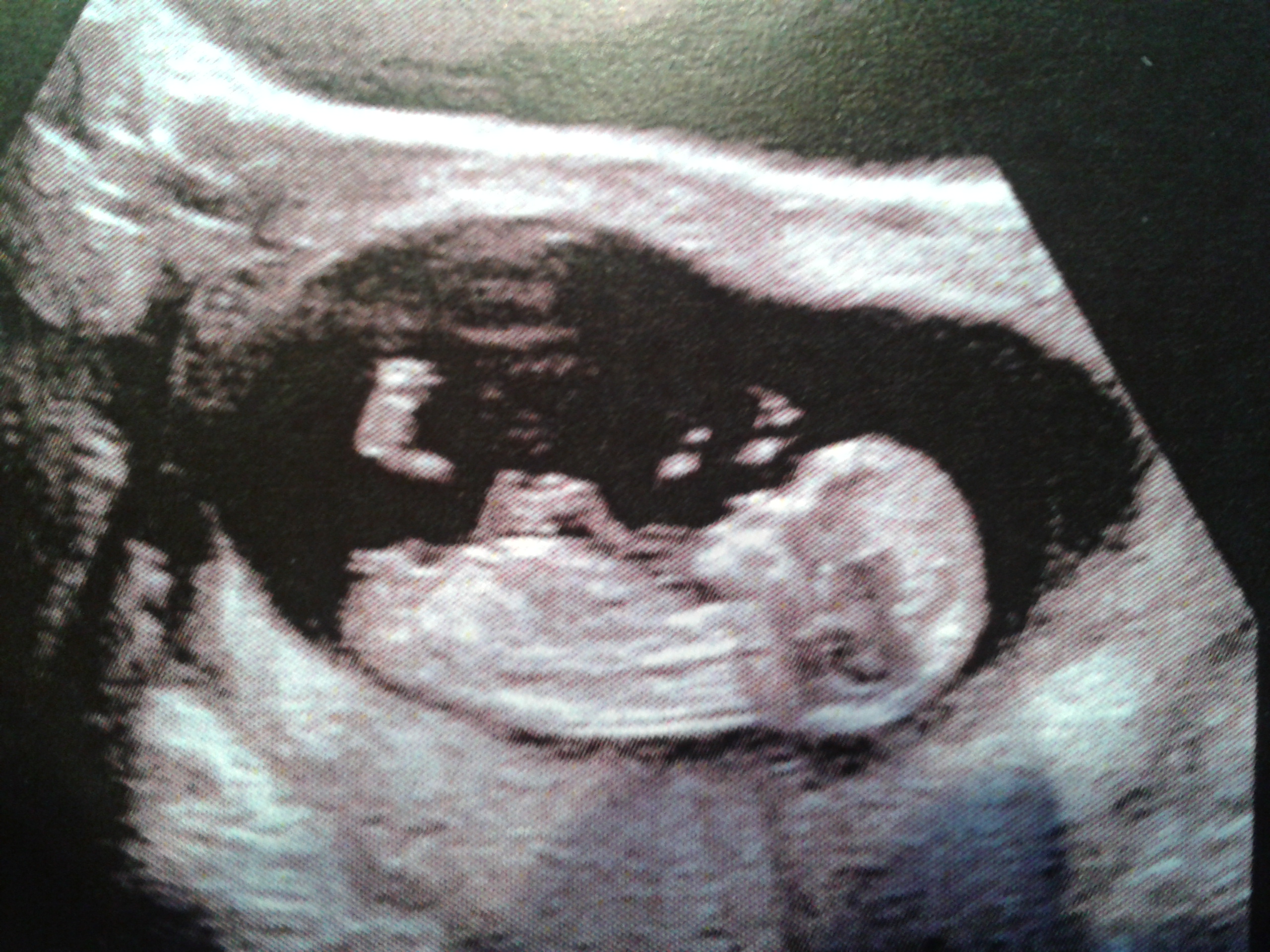 Echo 11 Sa 5 Fille Ou Garcon Echographie Connaitre Le Sexe De Votre Bebe Forum Grossesse Amp Bebe Doctissimo