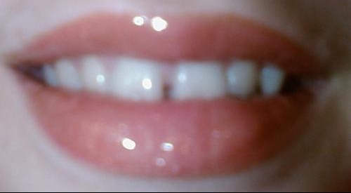 Dents Du Bonheur Photo Beaute Des Dents Forum Beaute Doctissimo Dents Du Bonheur Photo Beaute Des Dents Forum Beaute Doctissimo