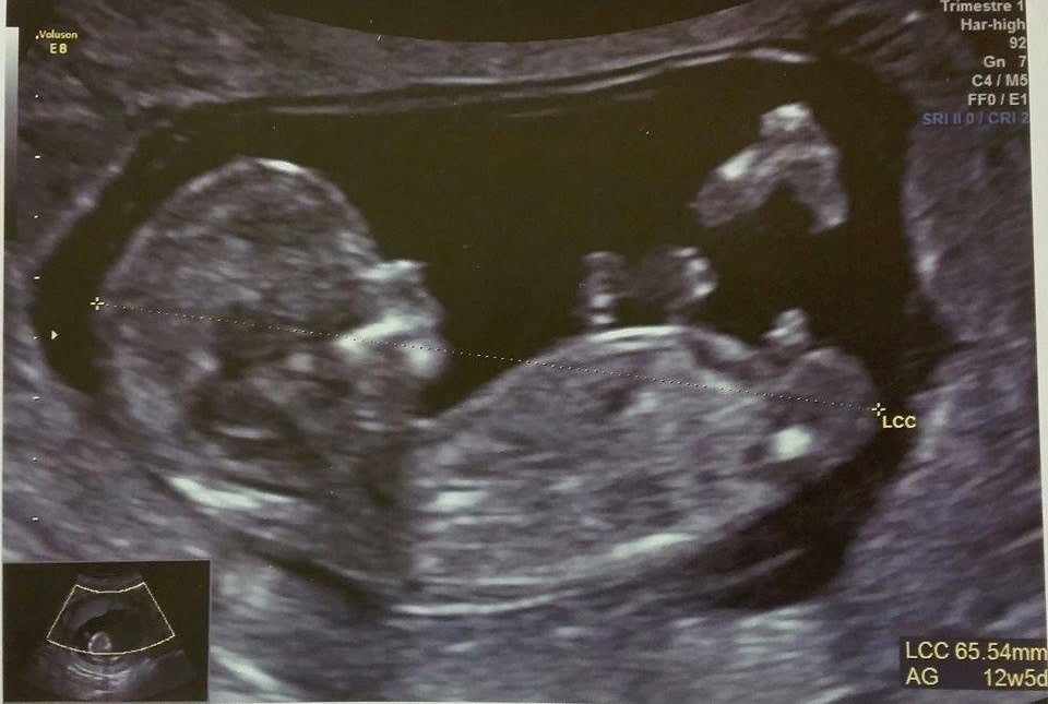 Echographie 13 Semaines Fille Ou Garcon Vos Avis Svp Futures Mamans Forum Grossesse Amp Bebe Doctissimo Echographie 13 Semaines Fille Ou Garcon Vos Avis Svp Futures Mamans Forum Grossesse Amp Bebe Doctissimo