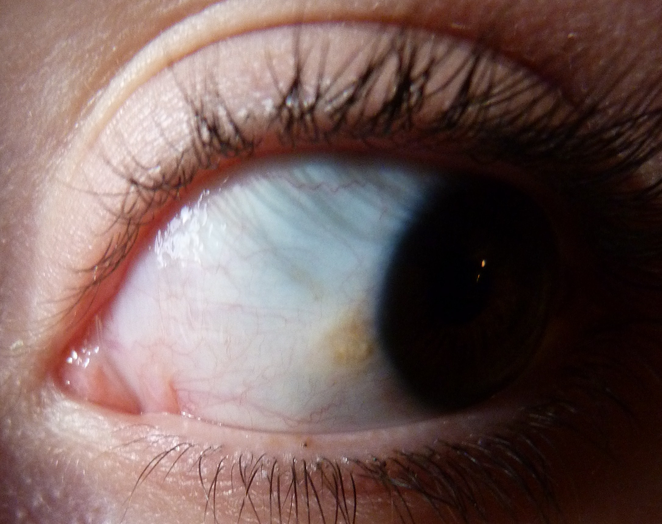 Taches Dans Les Yeux Myopie Cataracte Et Problemes De Vue Forum Sante Doctissimo Taches Dans Les Yeux Myopie Cataracte Et Problemes De Vue Forum Sante Doctissimo